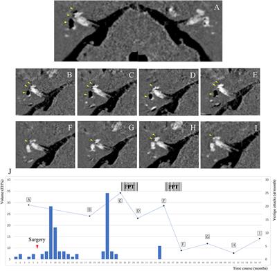 Case Report: Positive Pressure Therapy Combined With Endolymphatic sac Surgery in a Patient With Ménière's Disease